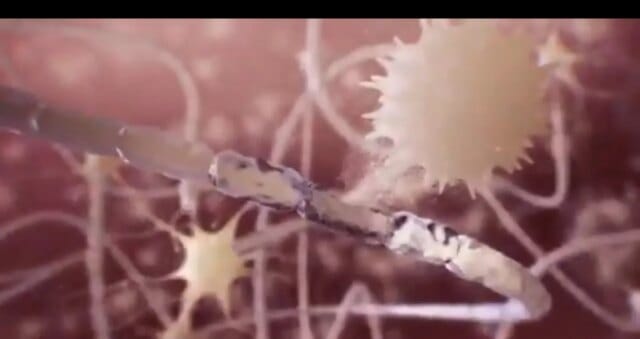 Experts warn of growing burden of Multiple Sclerosis in Kashmir during SKIMS Grand Round