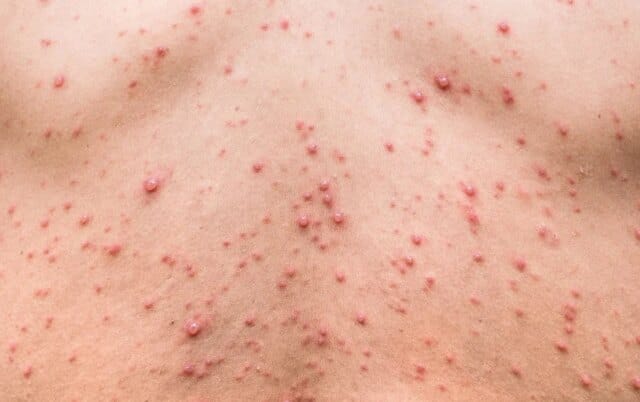 Door-to-door checks begin as chickenpox cases emerge in north Kashmir Chickenpox Outbreak Forces Closure of North Kashmir School Indefinitely